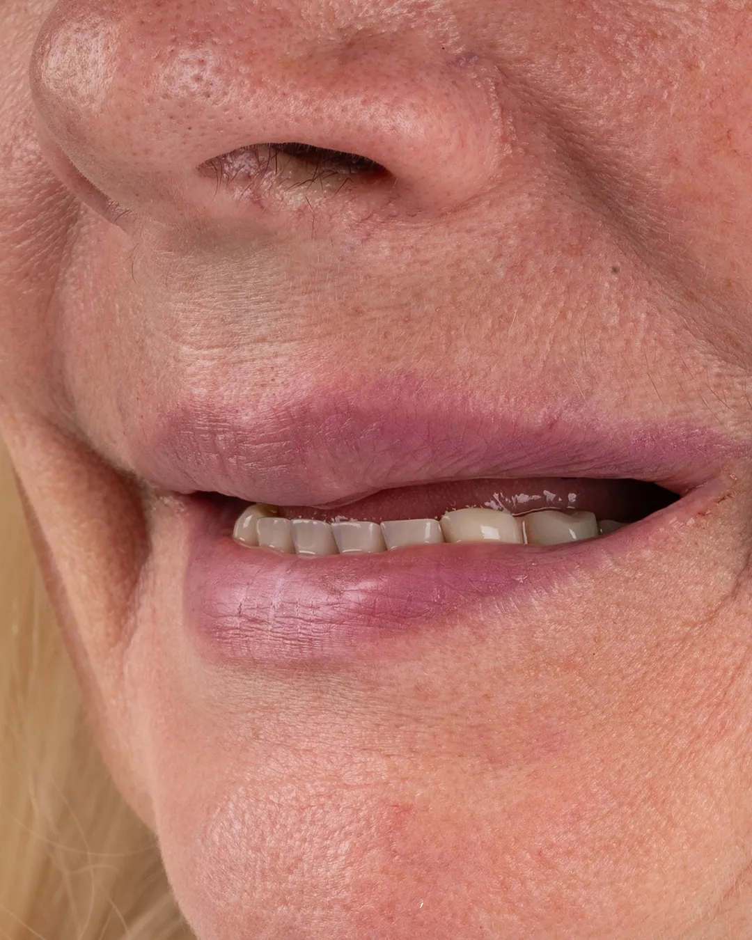 All on 4 Dental Implants